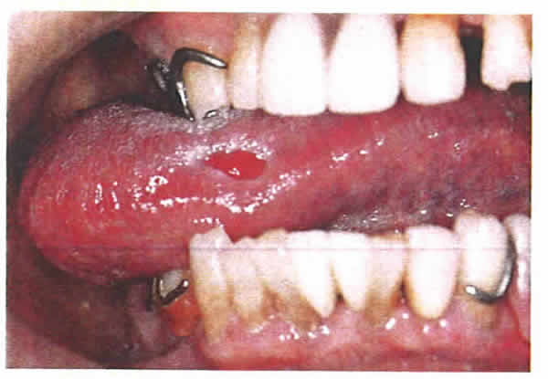 原因 痛み 舌 の 舌がむくんだら要注意！舌のむくみの原因と対処法