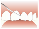 歯石除去の流れ
